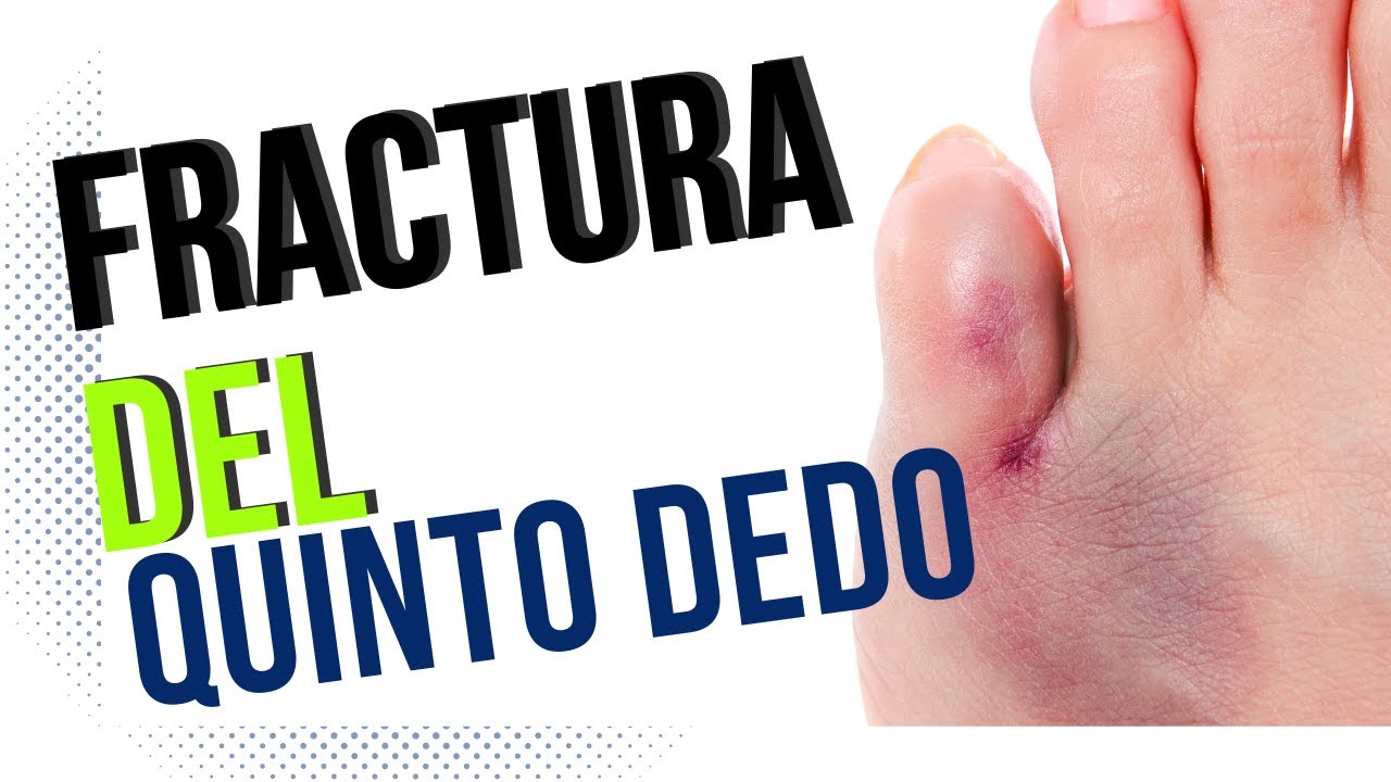 sindactilia vendaje dedo meñique mano
