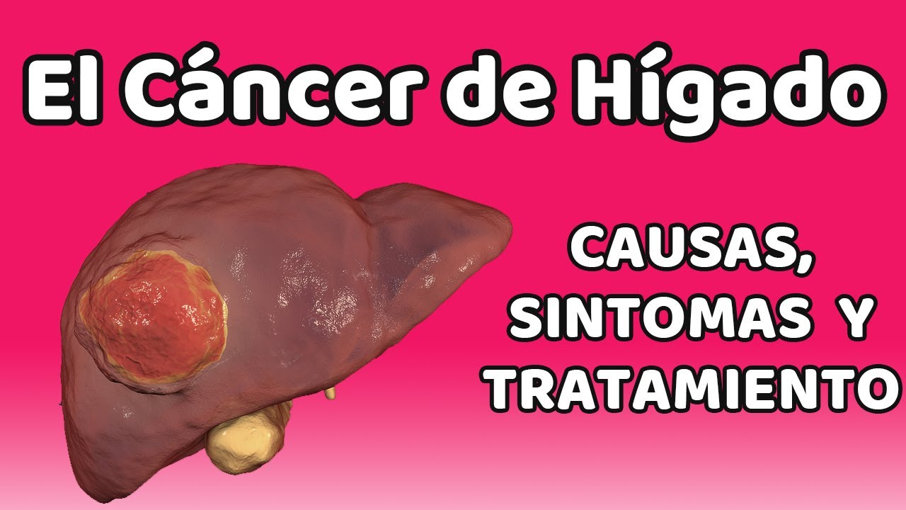 cáncer de hígado esperanza de vida