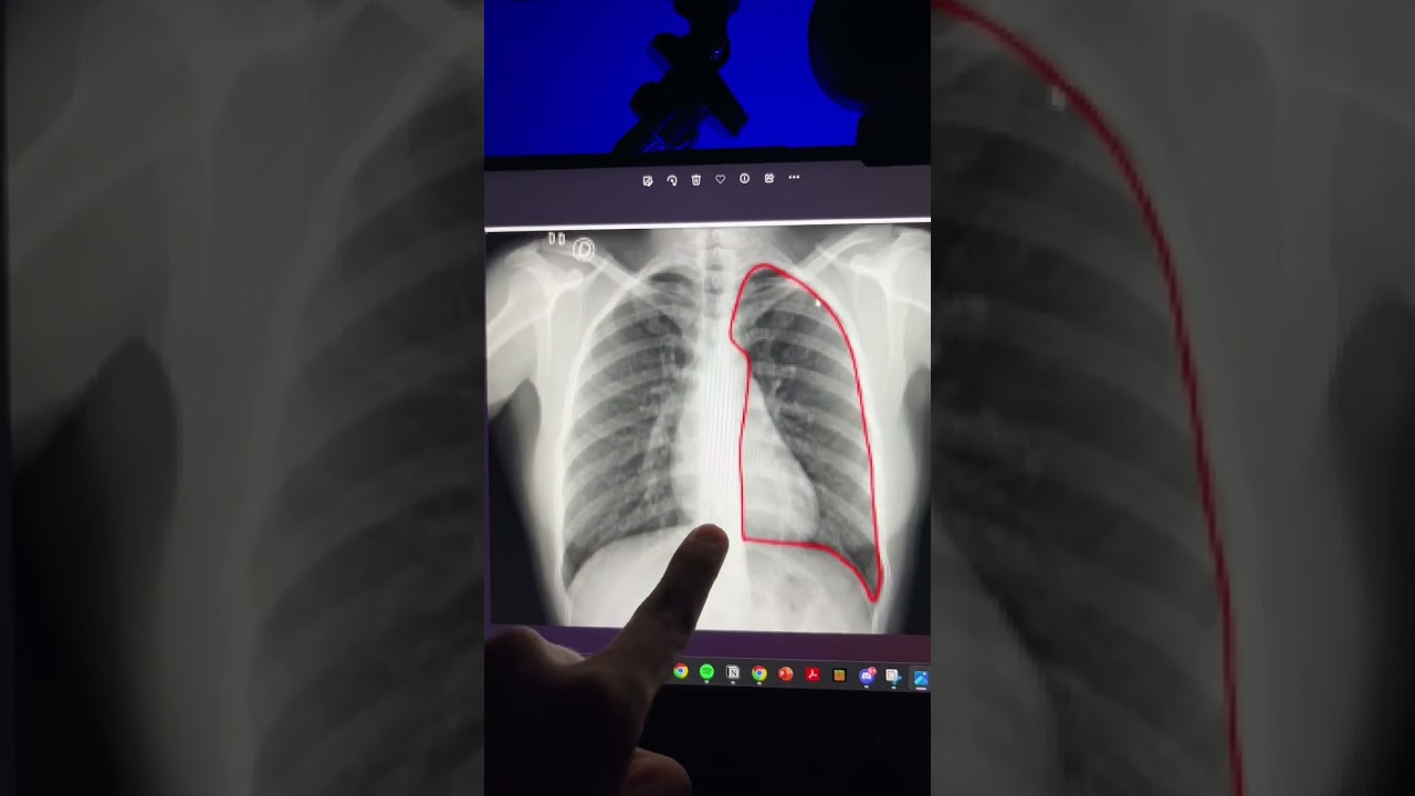 porque en una radiografía se observan zonas claras y oscuras